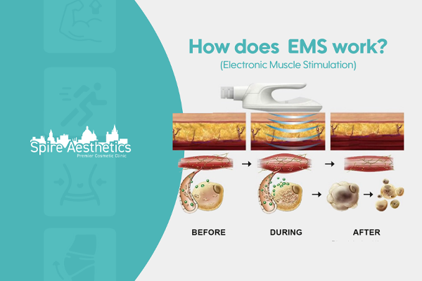 EMS treatment for post pregnancy weight loss treatment Liberton