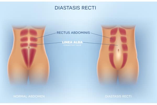 What Non-Surgical Options Are Available for Diastasis Recti Liberton?