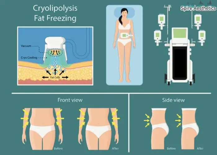 Fat freezing treatment Liberton benefits for competitions to remove stubborn fat deposits.