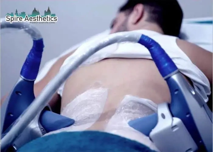 Man having fat freezing treatment done on love handles before a competitions Liberton to create a sculpted look.
