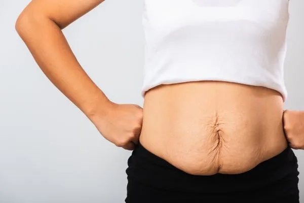 Image of a woman's stomach after weight loss with sagging skin following a gastric band Liberton