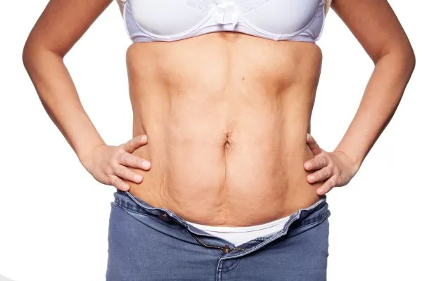 sagging skin on woman's stomach after weight loss injections Liberton