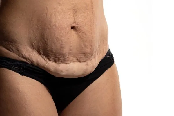 Image of womans stomach after weight loss injections Liberton showing saggy skin
